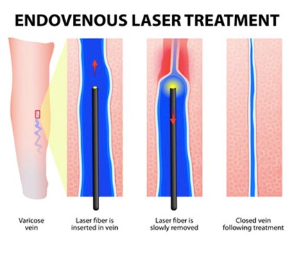 endovenous laserpic1