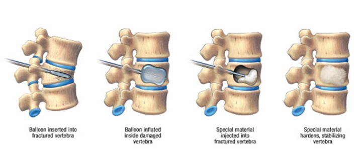 pair of two-step process illustrated cross section diagrams of kyphoplasty procedure: a balloon being injected into the vertebrae in one, and special material being injected to the vertebrae in the other