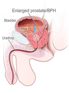 prostate arterypic