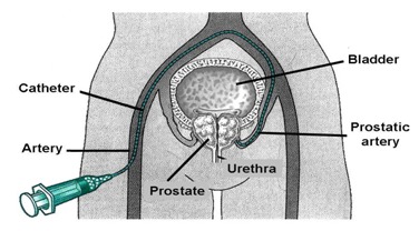 prostate arterypic2