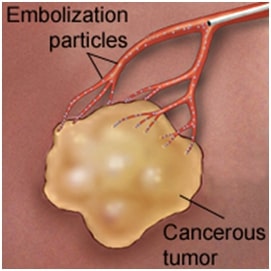 drawing of cancerous tumor and embolization particles