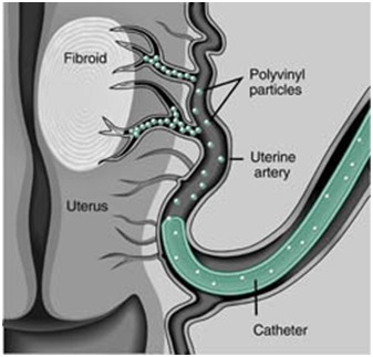 uterin fibroid2