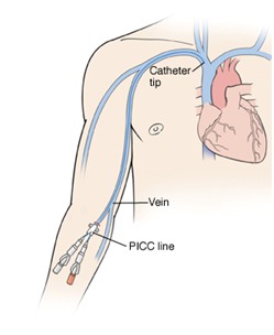 vascular access