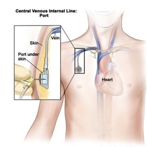 illustration of human male with with cross section of heart and zoomed in on mediport vascular access device connected to catheter running through vein