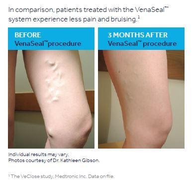 Varicose Veins Before & After image