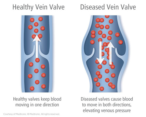 Difference between healthy vein valve & diseased vein valve
