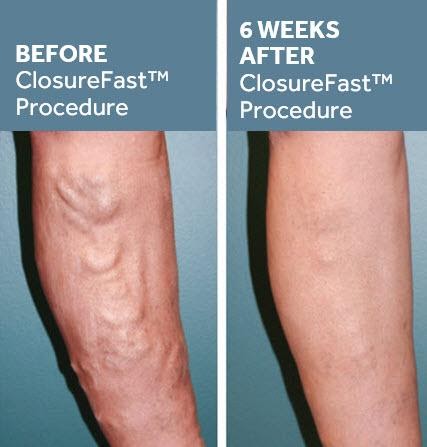 Varicose Vein Treatment Before & After Photo
