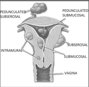 uterine fibroids in a Uterus