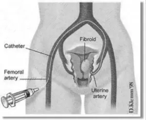 Microcatheter being inserted into the femoral artery.