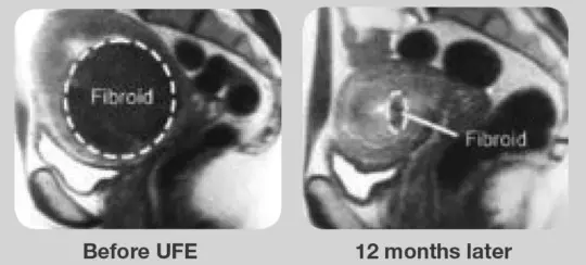 Before and 12 months after UFE procedure.