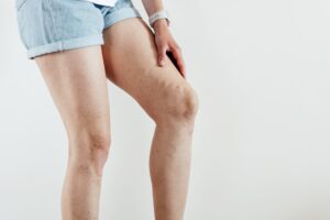 Woman with varicose veins