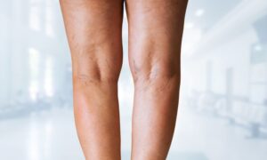 Painful,Varicose,And,Spider,Veins,On,Active,Woman's,And,Men